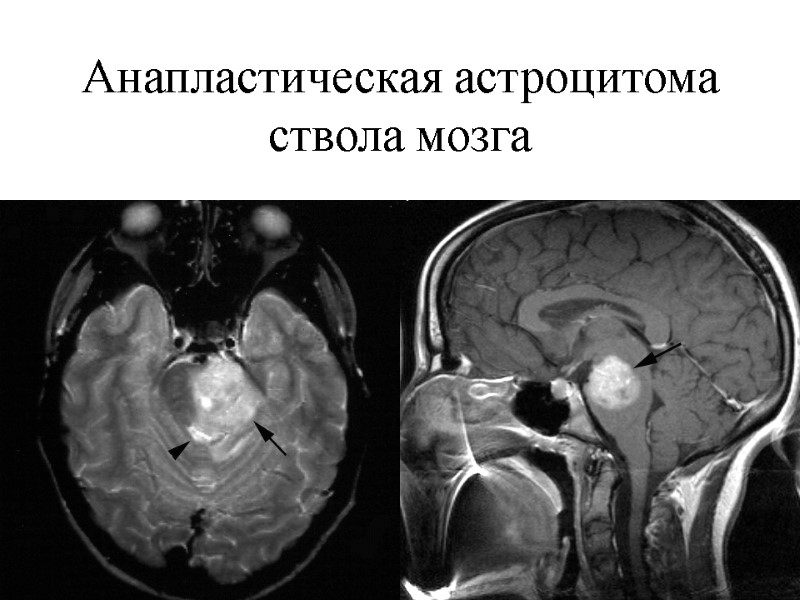 Анапластическая астроцитома ствола мозга